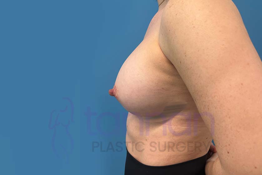 Breast-Augmentation-Aftere-8402-Tannan-Plastic-Surgery