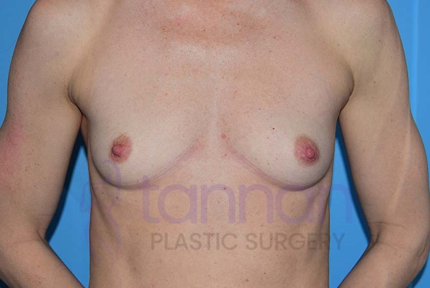Breast-Augmentation-Before-7801-Tannan-Plastic-Surgery