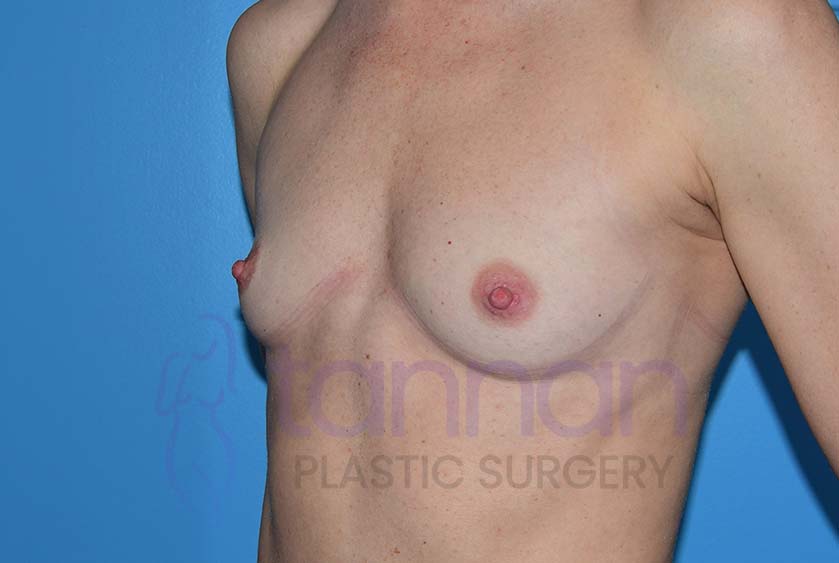 Breast-Augmentation-Before-7802-Tannan-Plastic-Surgery
