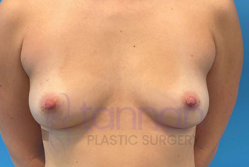 Breast-Augmentation-Before-7901-Tannan-Plastic-Surgery