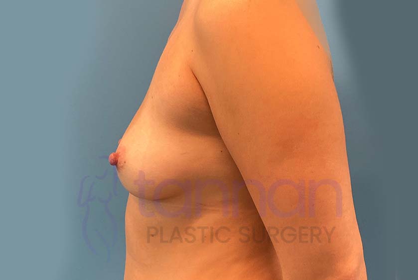Breast-Augmentation-Before-7902-Tannan-Plastic-Surgery