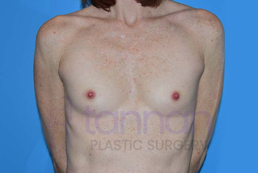 Breast-Augmentation-Before-8001-Tannan-Plastic-Surgery