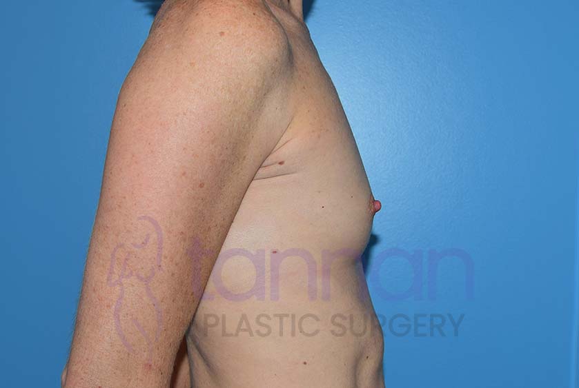 Breast-Augmentation-Before-8002-Tannan-Plastic-Surgery