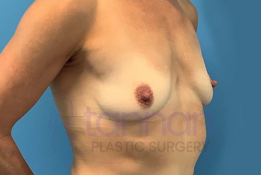 Breast-Augmentation-Before-8102-Tannan-Plastic-Surgery