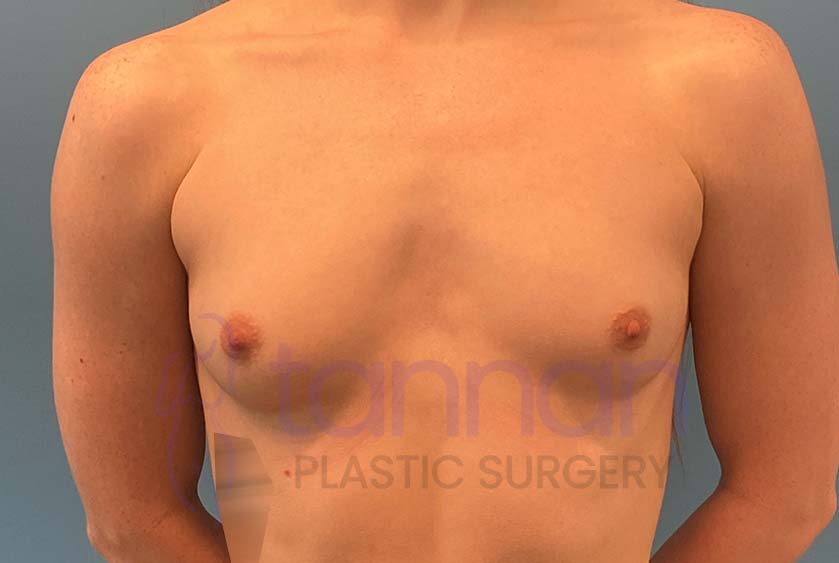 Breast-Augmentation-Before-8301-Tannan-Plastic-Surgery