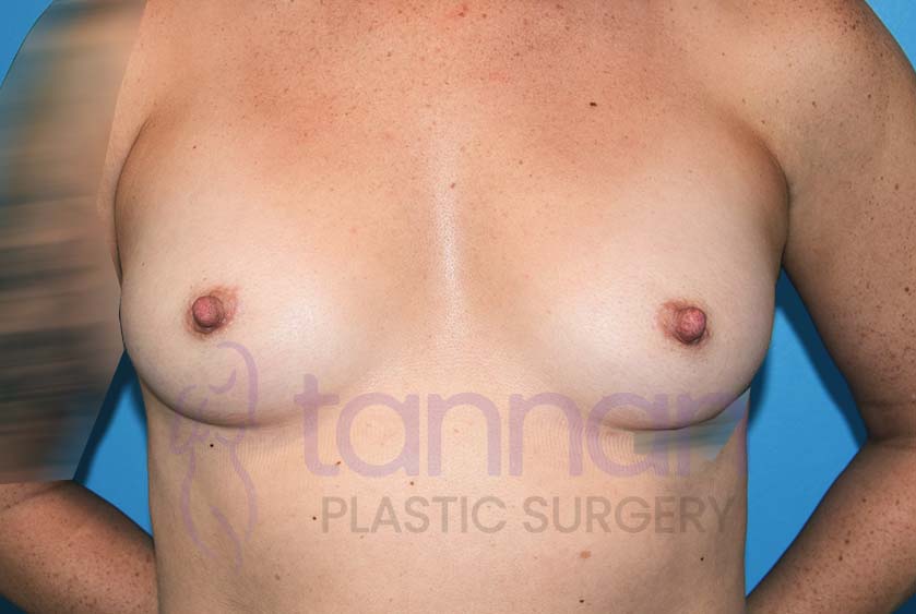 Breast-Augmentation-Before-8401-Tannan-Plastic-Surgery