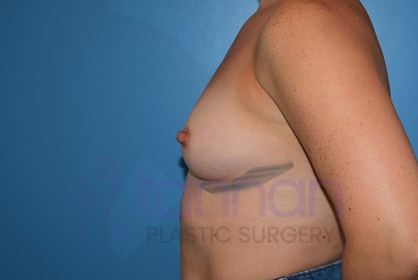 Breast-Augmentation-Before-8402-Tannan-Plastic-Surgery