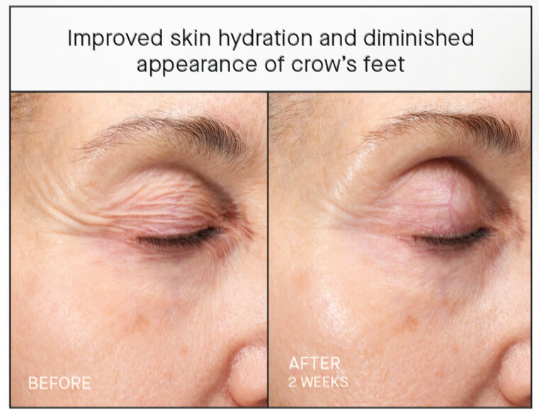 Ourself-Before & After 8 Ourself before & after diminished crow's feet