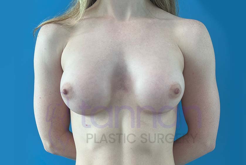Breast-Augmentation-After-8501-Tannan-Plastic-Surgery