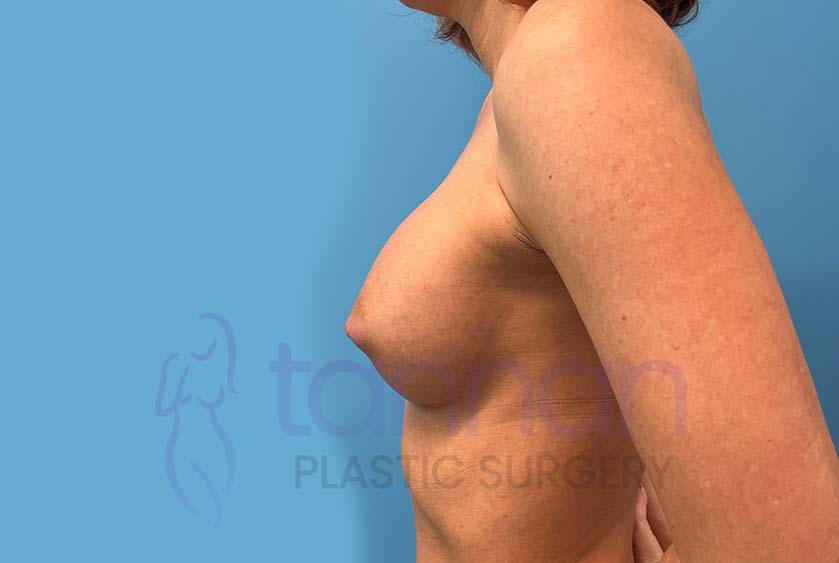 Breast-Augmentation-After-8802-Tannan-Plastic-Surgery