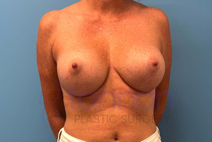 Breast-Augmentation-After-8901-Tannan-Plastic-Surgery