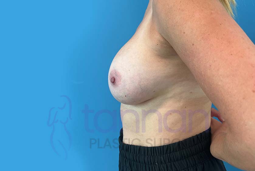 Breast-Augmentation-After-9102-Tannan-Plastic-Surgery