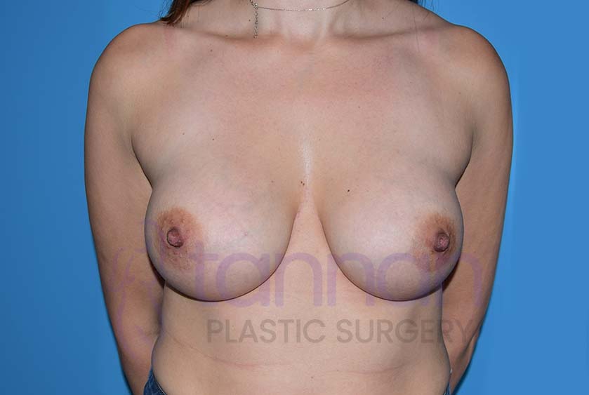 Breast-Augmentation-After-9201-Tannan-Plastic-Surgery