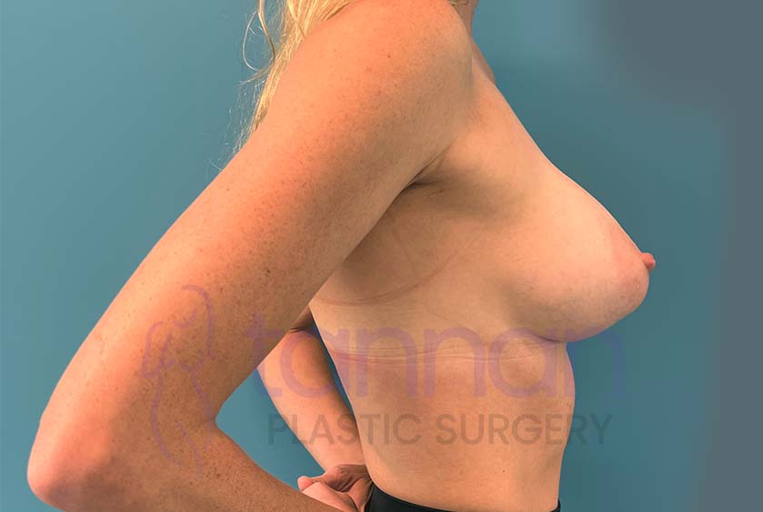 Breast-Augmentation-After-9302-Tannan-Plastic-Surgery