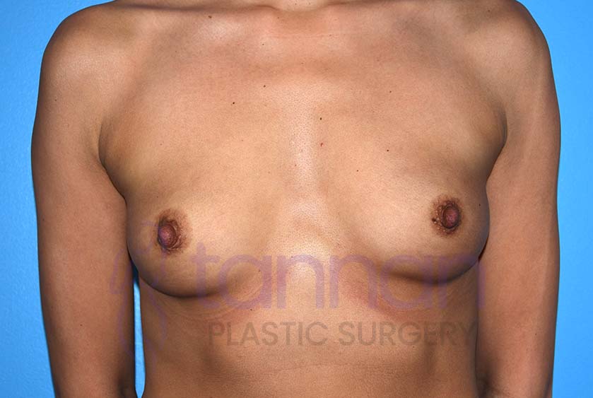 Breast-Augmentation-Before-8701-Tannan-Plastic-Surgery