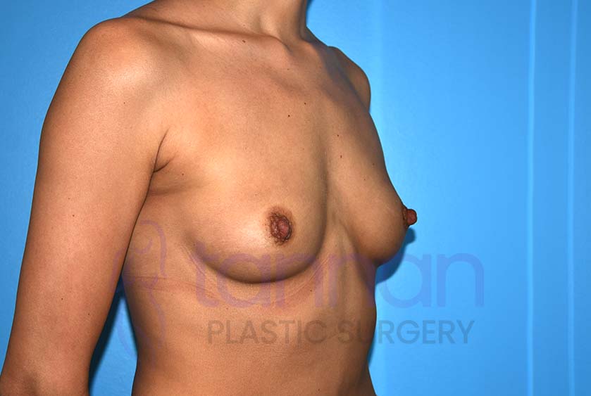 Breast-Augmentation-Before-8702-Tannan-Plastic-Surgery