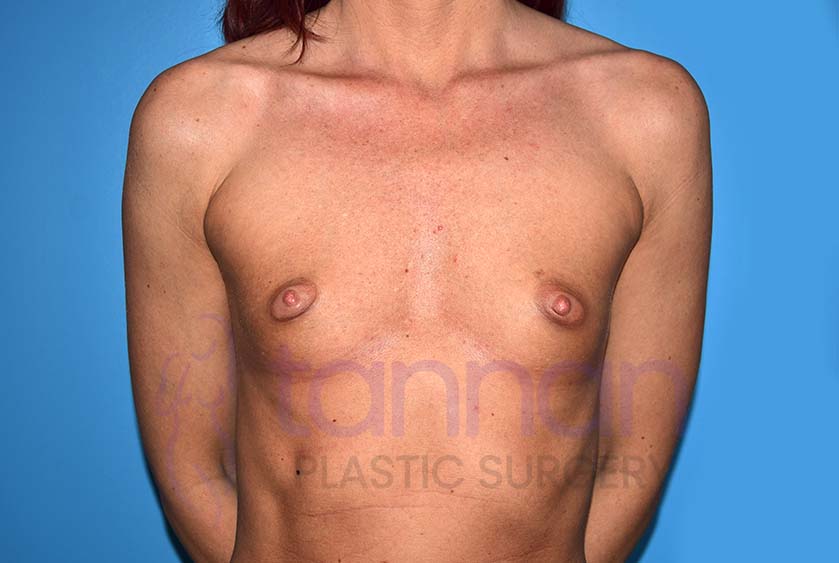 Breast-Augmentation-Before-8801-Tannan-Plastic-Surgery