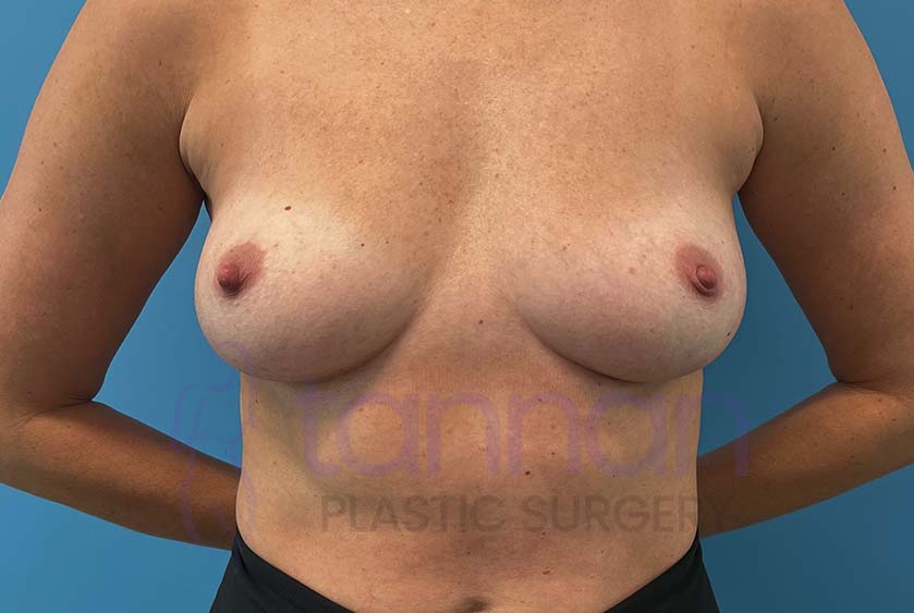 Breast-Augmentation-Before-9101-Tannan-Plastic-Surgery