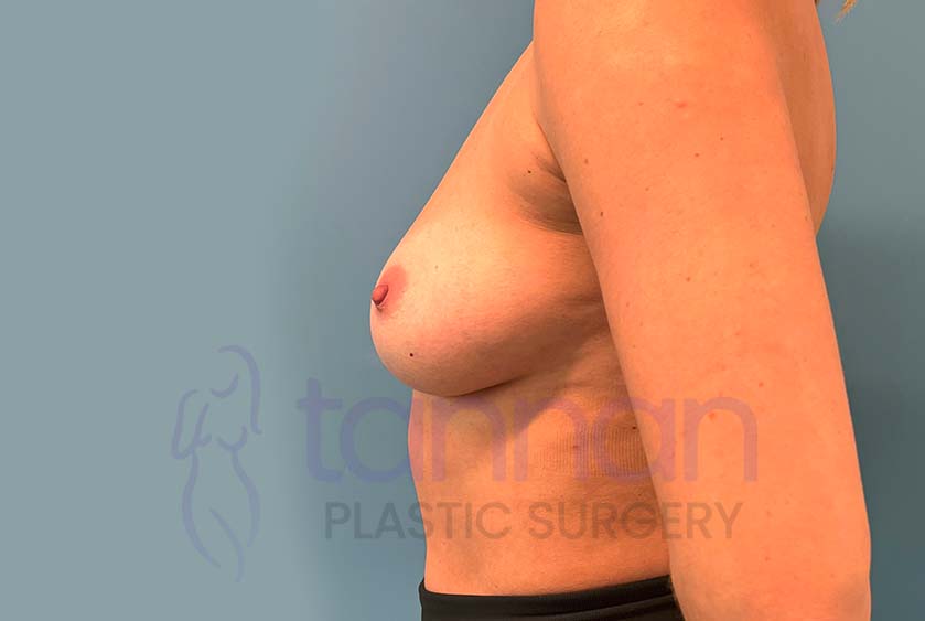 Breast-Augmentation-Before-9102-Tannan-Plastic-Surgery