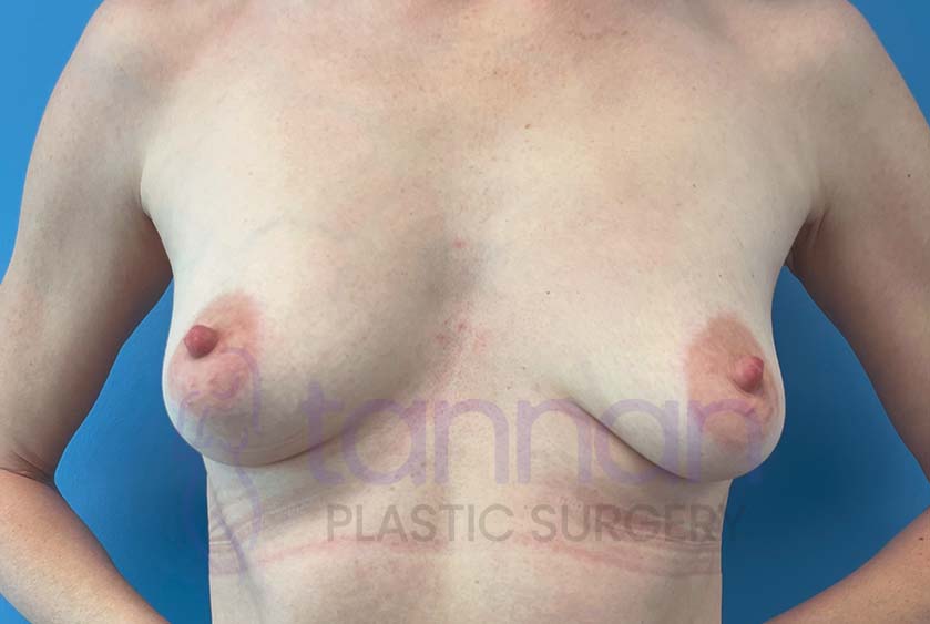 Breast-Augmentation-Before-9301-Tannan-Plastic-Surgery