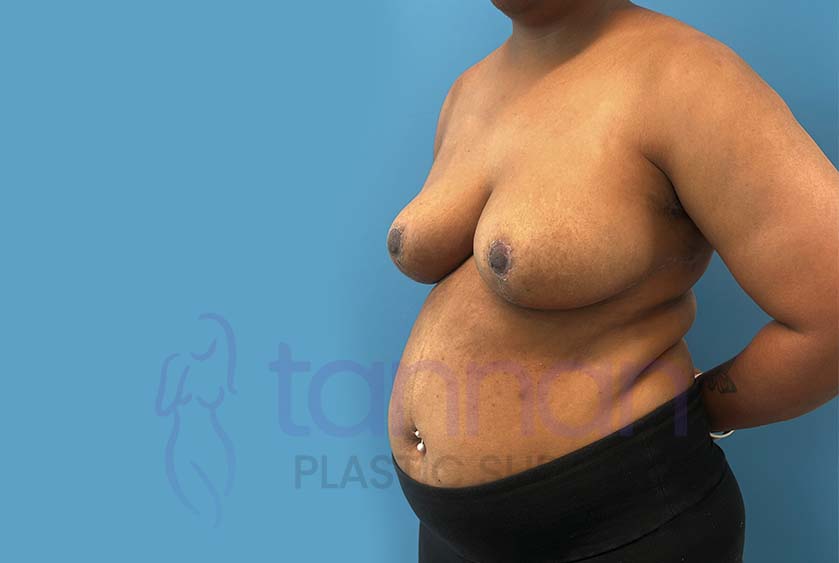 Breast-Reduction-After-3502-Tannan-Plastic-Surgery