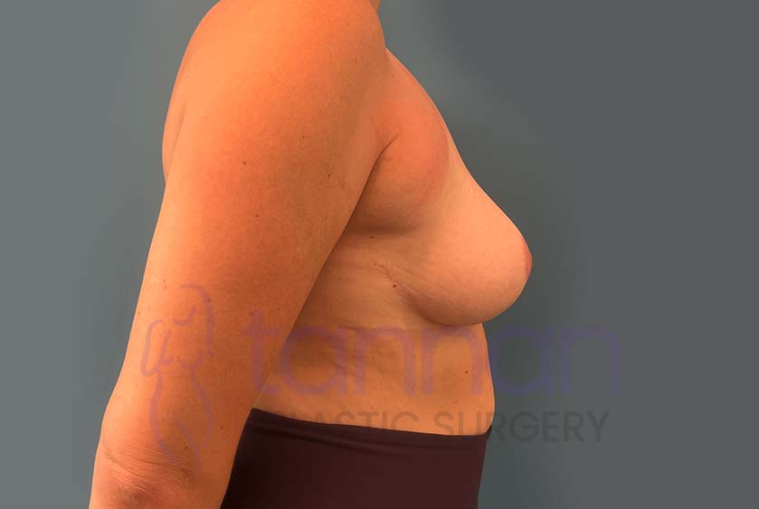 Breast-Reduction-After-3602-Tannan-Plastic-Surgery