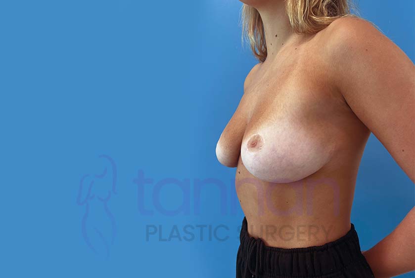 Breast-Reduction-After-3702-Tannan-Plastic-Surgery