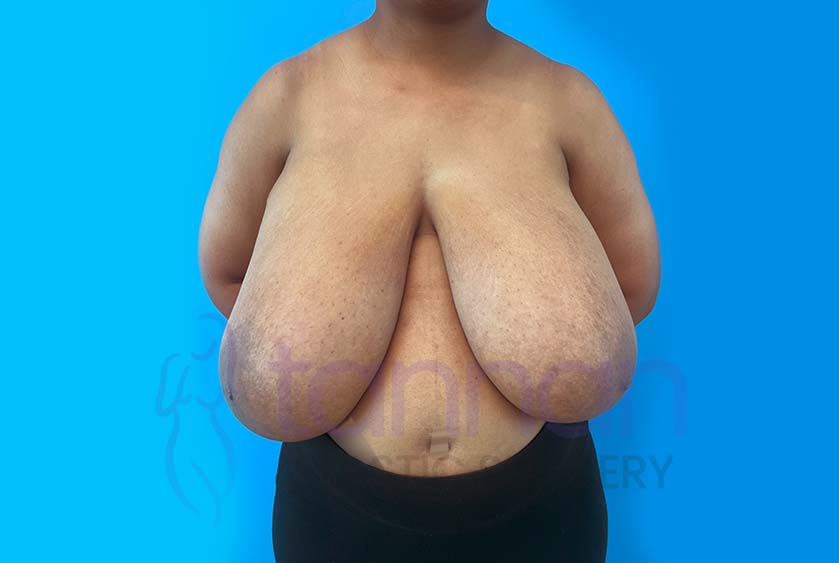 Breast-Reduction-Before-3501-Tannan-Plastic-Surgery