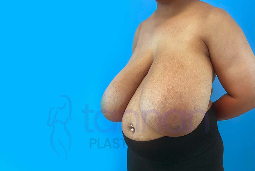 Breast-Reduction-Before-3502-Tannan-Plastic-Surgery