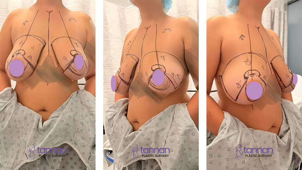 breast-reduction-surgery-marks-Tannan-Plastic-Surgery-1024x684 Marks made before breast reduction surgery