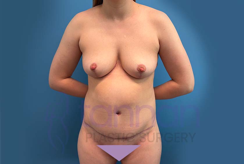 Mommy-Makeover-after-2501-Tannan-Plastic-Surgery
