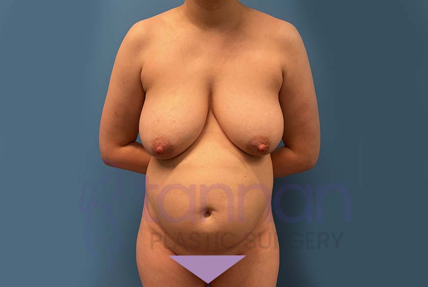 Mommy-Makeover-before-2501-Tannan-Plastic-Surgery