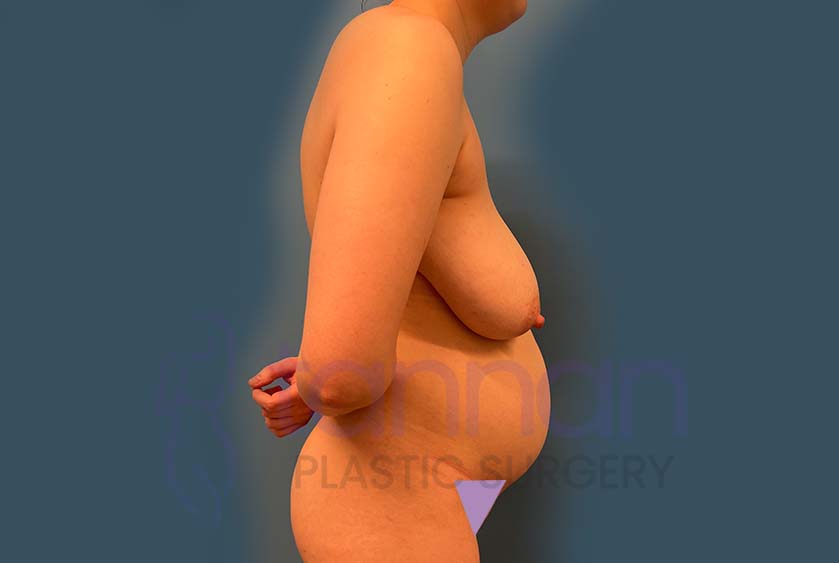 Mommy-Makeover-before-2502-Tannan-Plastic-Surgery