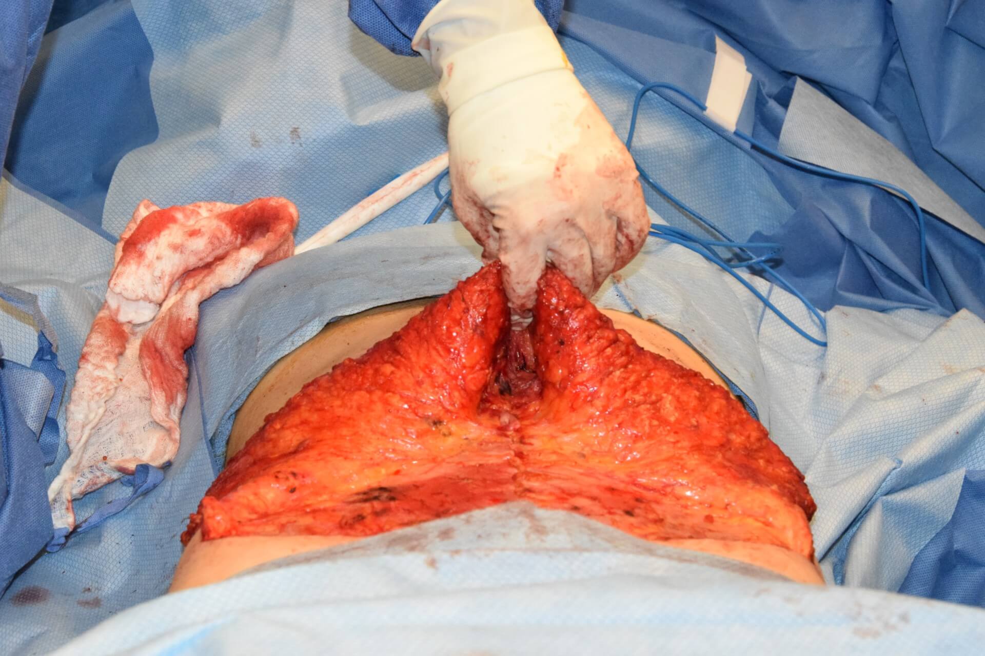 internal view of diastasis recti after repair