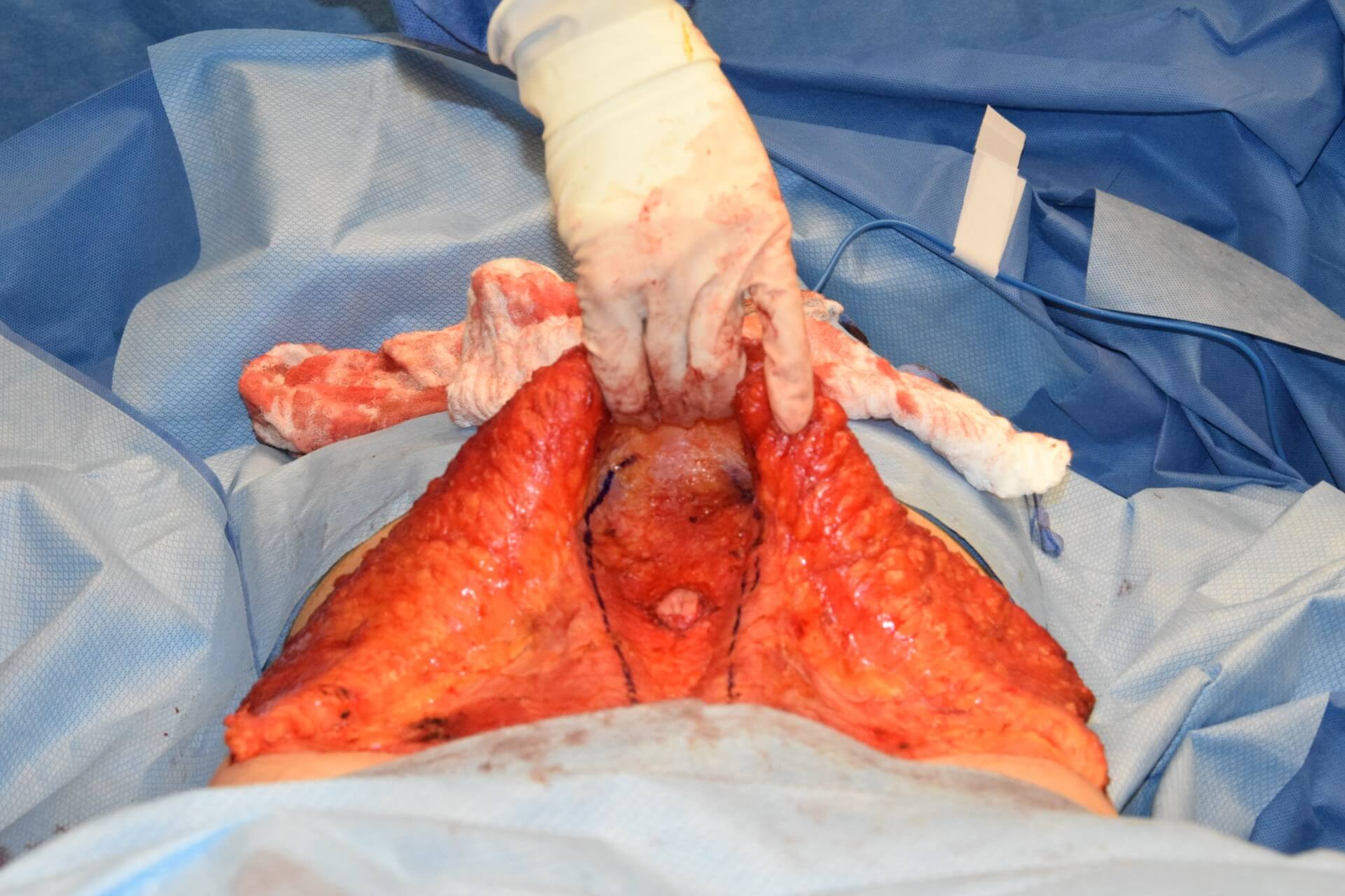 internal view of diastasis recti before repair