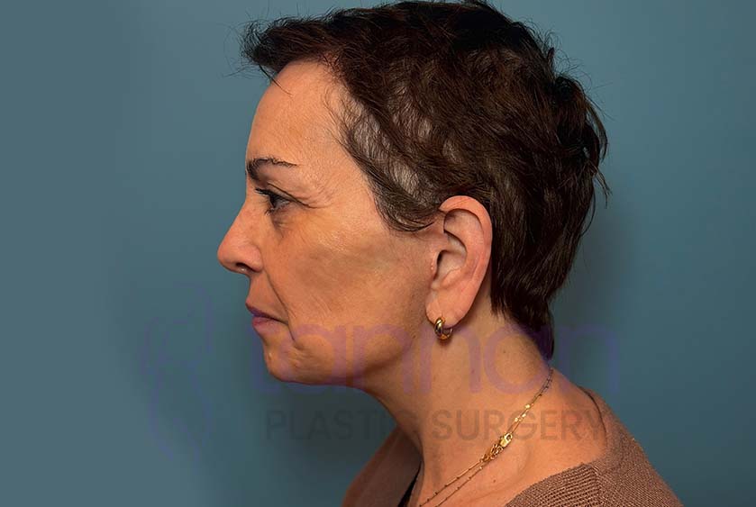 Facelift Side View - After