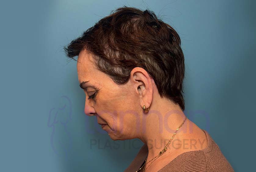 Facelift Side Down View - After