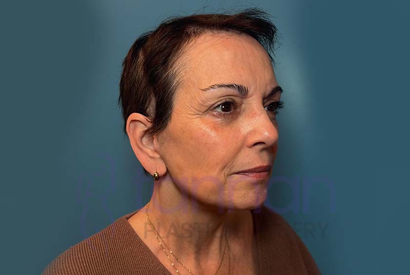 Facelift Oblique View - After