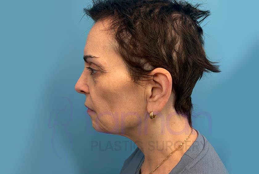 Facelift Side View - Before