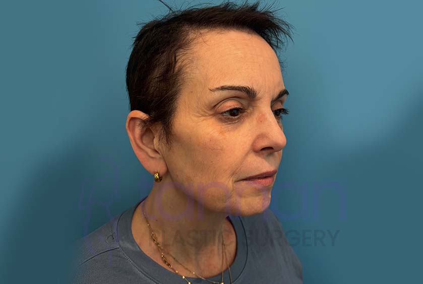 Facelift Oblique View - Before
