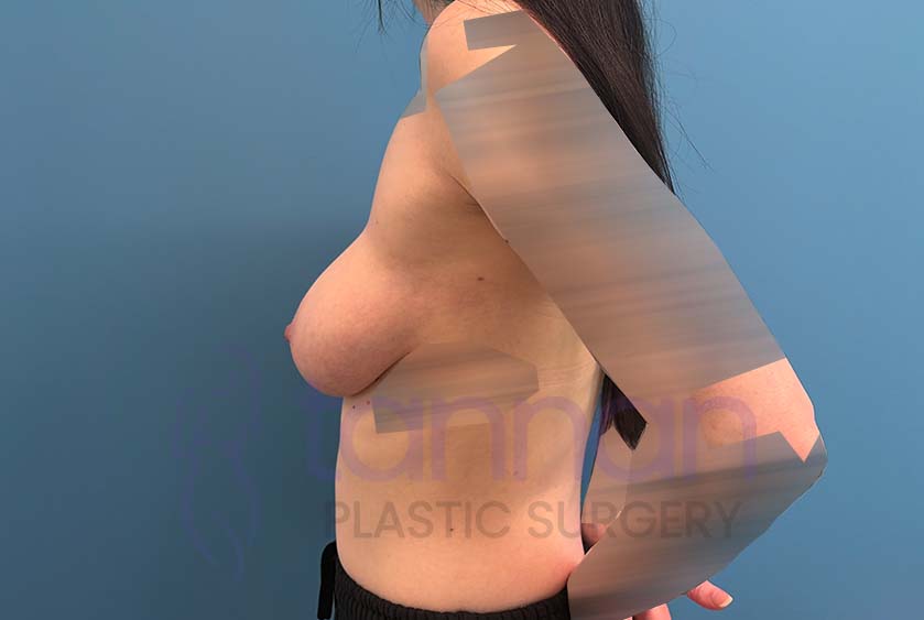 Breast-Augmentation-after-11502-Tannan-Plastic-Surgery