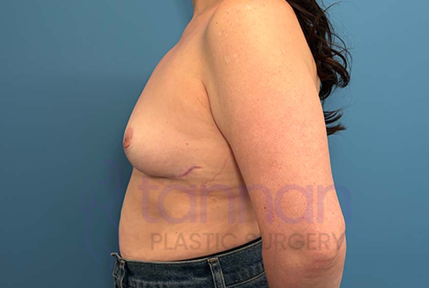 Breast-Lift-After-3302-Tannan-Plastic-Surgery