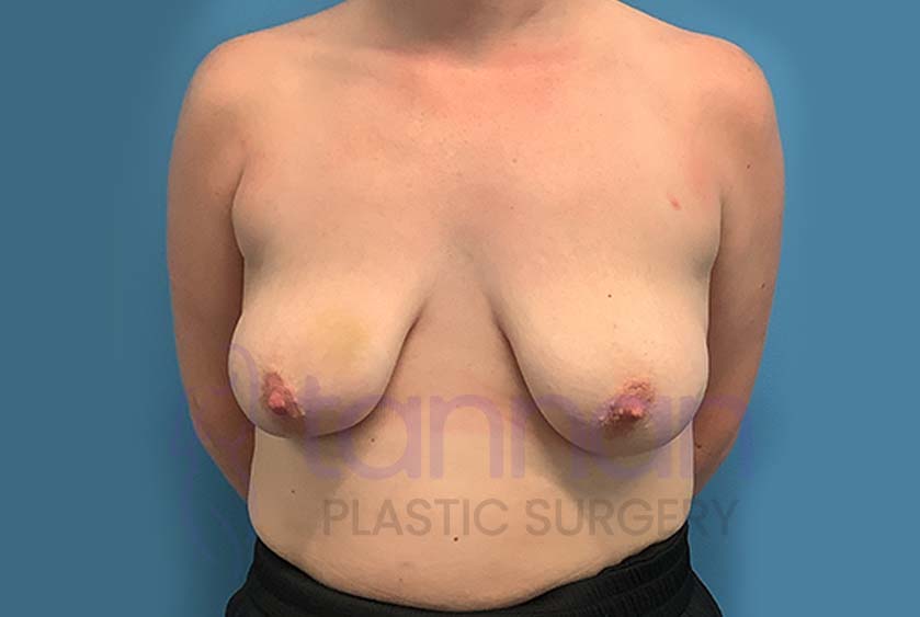 Breast-Lift-Before-2801-Tannan-Plastic-Surgery