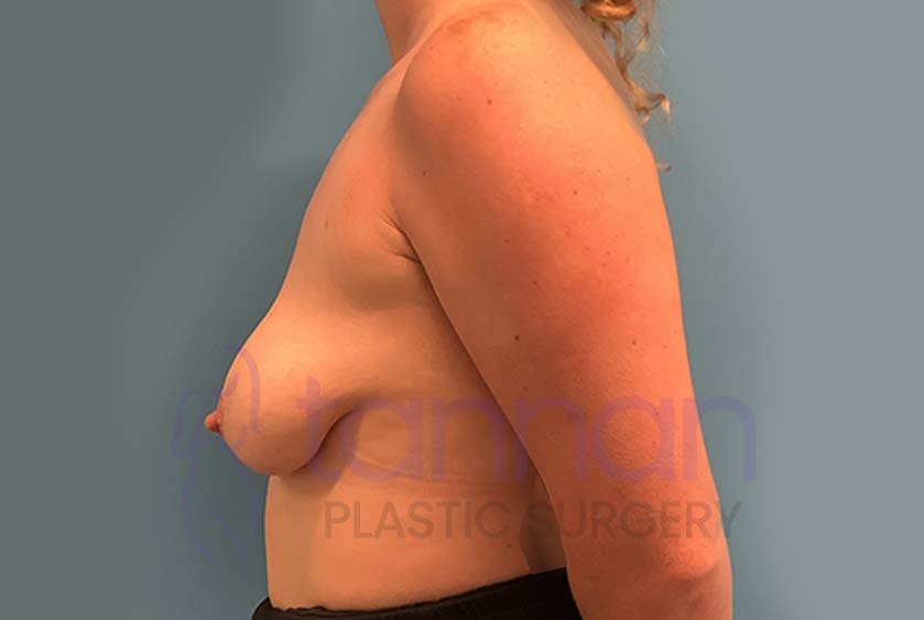 Breast-Lift-Before-2802-Tannan-Plastic-Surgery