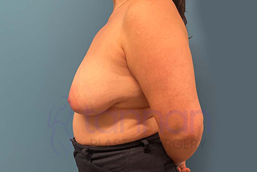 Breast-Lift-Before-3302-Tannan-Plastic-Surgery