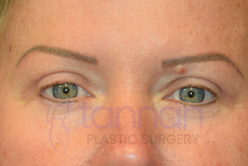 Eyelid surgery after photo front view