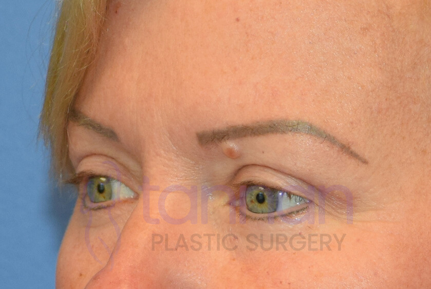 Eyelid surgery before photo oblique view