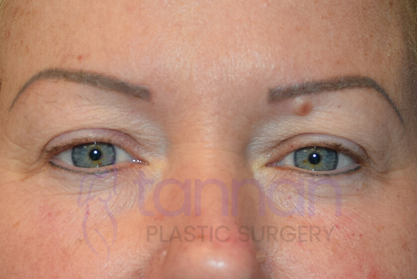 Bleph-Before-0501-Tannan-Plastic-Surgery Eyelid surgery before photo front view