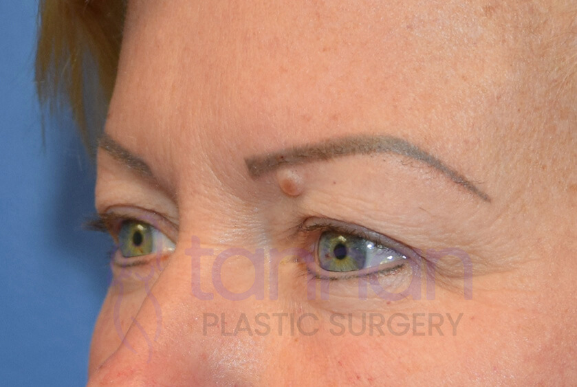 Eyelid surgery before photo oblique view