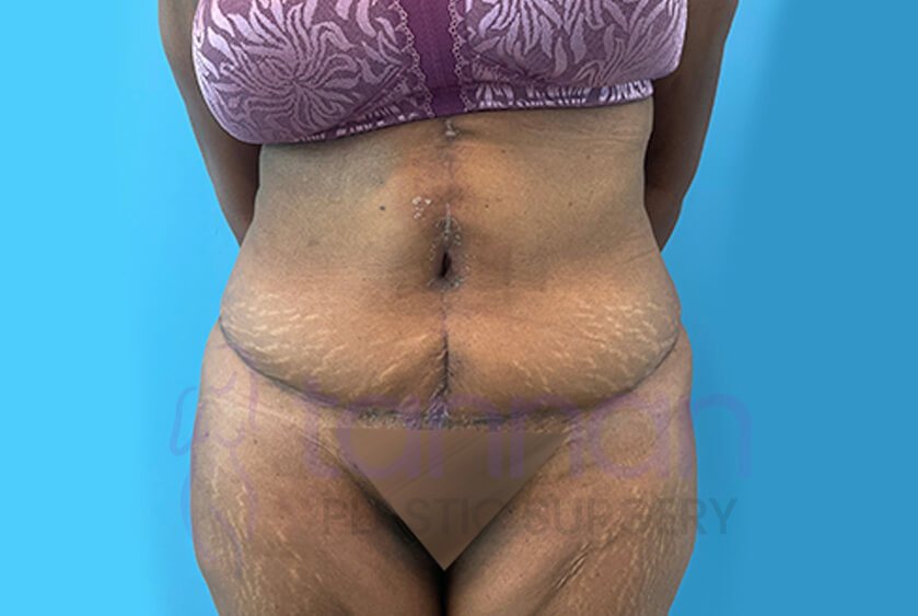 Fleur De Lis Abdominoplasty front view after - Tannan Plastic Surgery